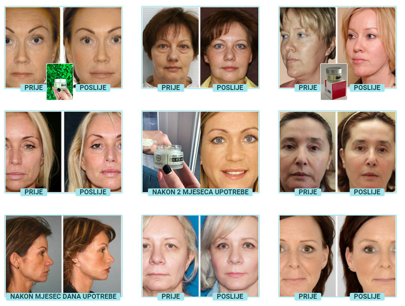 Iskustvo u korištenju kreme BioLift.